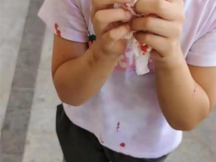 電梯頂?shù)袈湓覀?歲女孩致其流血毀容，賠償事宜難以達(dá)成